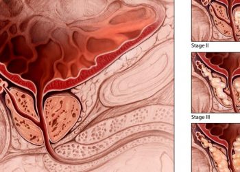 Mjekësia alternative ofron mundësinë se si të zvogëloni rrezikun ndaj kancerit të prostatës