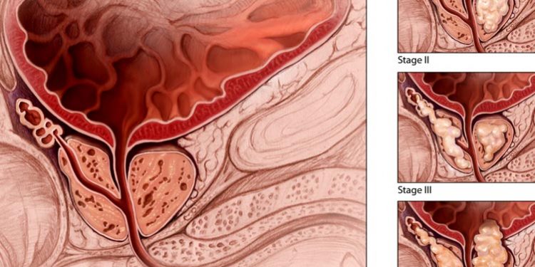 Mjekësia alternative ofron mundësinë se si të zvogëloni rrezikun ndaj kancerit të prostatës