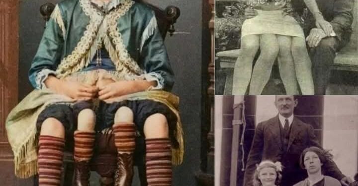 Myrtle Corbin, “Vajza me Katër Këmbë nga Teksasi”, hiri i një trupi ndryshe dhe krenaria për të qenë vetvetja